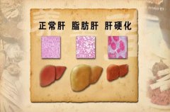 健康！紅酒竟是脂肪肝“天敵”